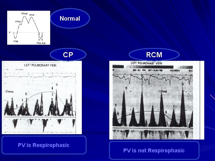 Normal CP PV is Respirophasic RCM PV is not Respirophasic 