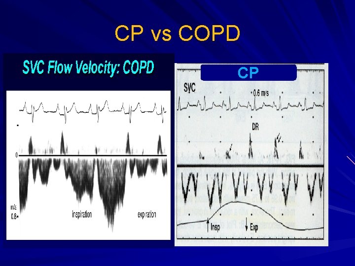 CP vs COPD CP 