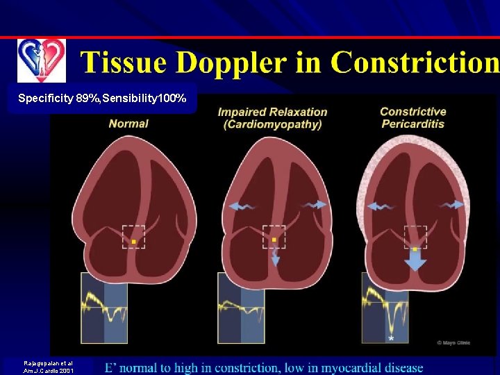 Specificity 89%, Sensibility 100% Rajagopalan et al. Am. J. Cardio 2001 