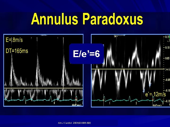 E/e’=6 Am J Cardiol 2004; 93: 886 -890 