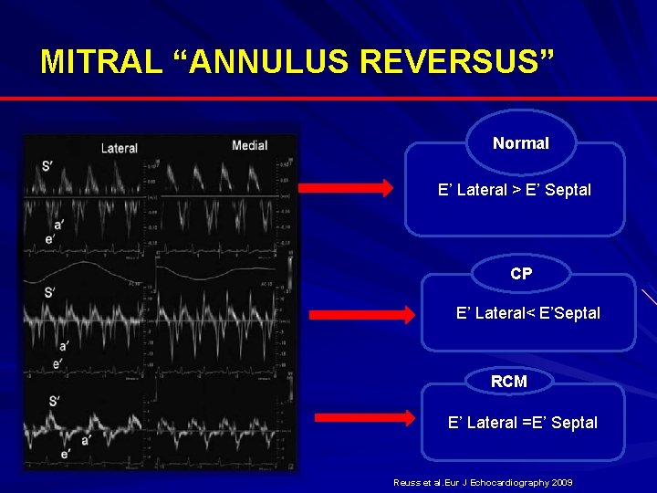 MITRAL “ANNULUS REVERSUS” Normal E’ Lateral > E’ Septal CP E’ Lateral< E’Septal RCM