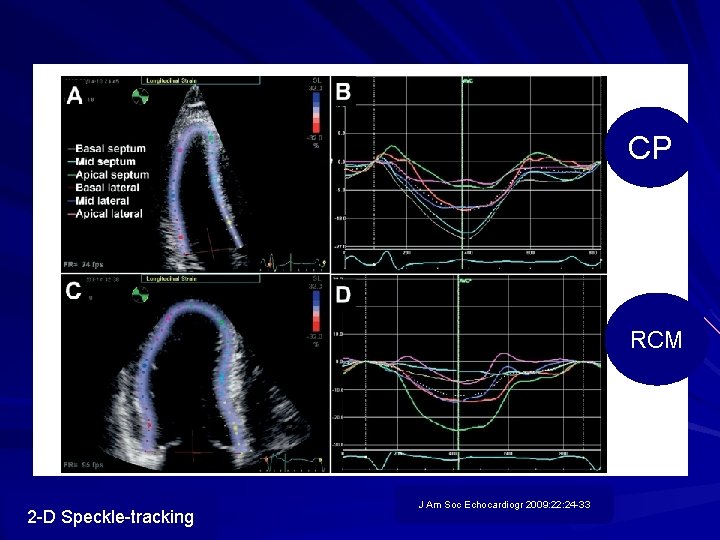 CP RCM 2 -D Speckle-tracking J Am Soc Echocardiogr 2009: 22: 24 -33 