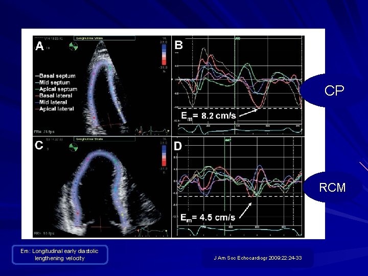 CP RCM Em: Longitudinal early diastolic lengthening velocity J Am Soc Echocardiogr 2009: 22: