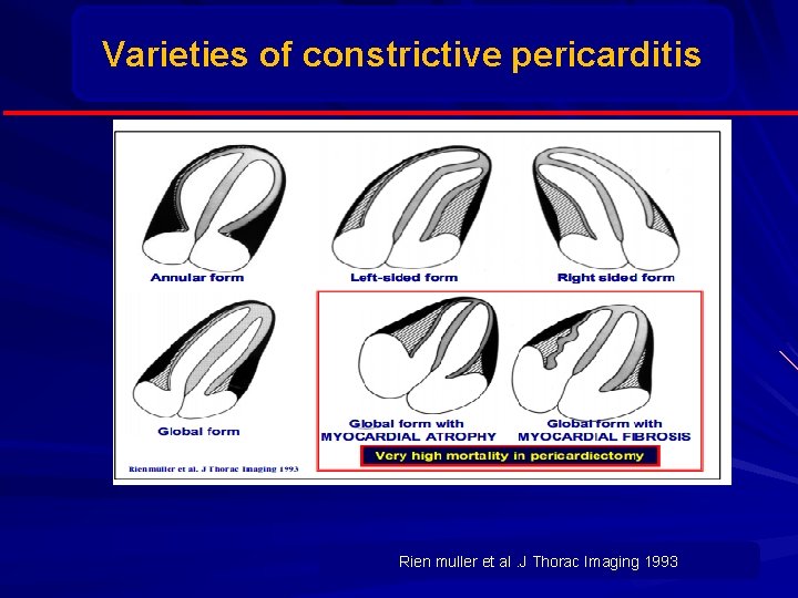 Varieties of constrictive pericarditis Rien muller et al. J Thorac Imaging 1993 