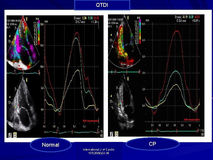 QTDI Normal CP International J of Cardio 137(2009)22 -39 