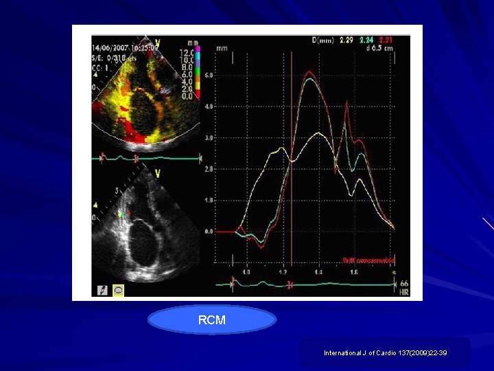 RCM International J of Cardio 137(2009)22 -39 