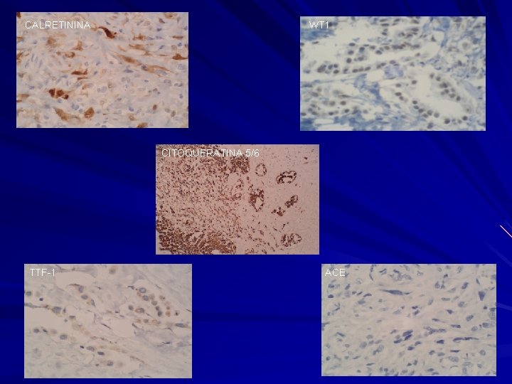 CALRETININA WT 1 CITOQUERATINA 5/6 TTF-1 ACE 