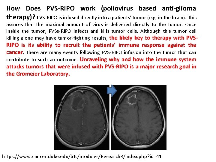 How Does PVS-RIPO work (poliovirus based anti-glioma therapy)? PVS-RIPO is infused directly into a