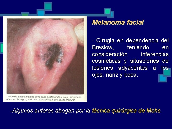 Melanoma facial - Cirugía en dependencia del Breslow, teniendo en consideración inferencias cosméticas y