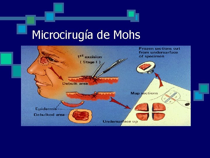 Microcirugía de Mohs 