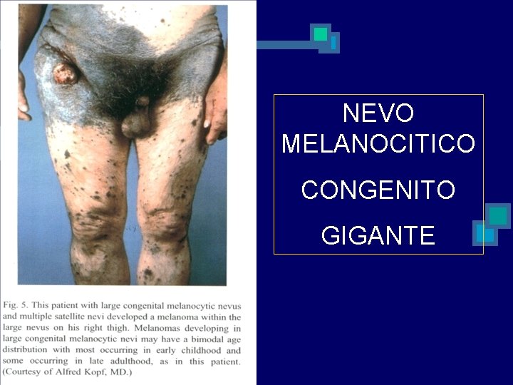 NEVO MELANOCITICO CONGENITO GIGANTE 