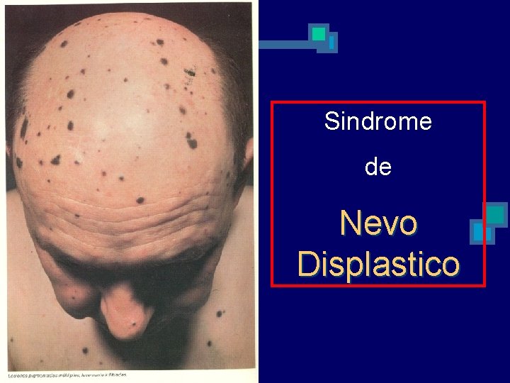 Sindrome de Nevo Displastico 