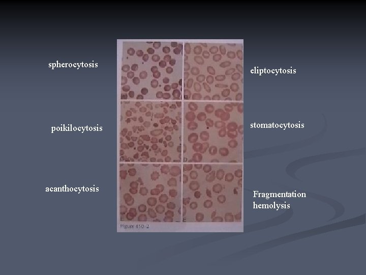 spherocytosis poikilocytosis acanthocytosis eliptocytosis stomatocytosis Fragmentation hemolysis 