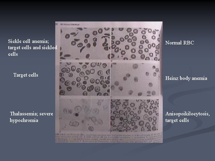 Sickle cell anemia; target cells and sickled cells Target cells Thalassemia; severe hypochromia Normal