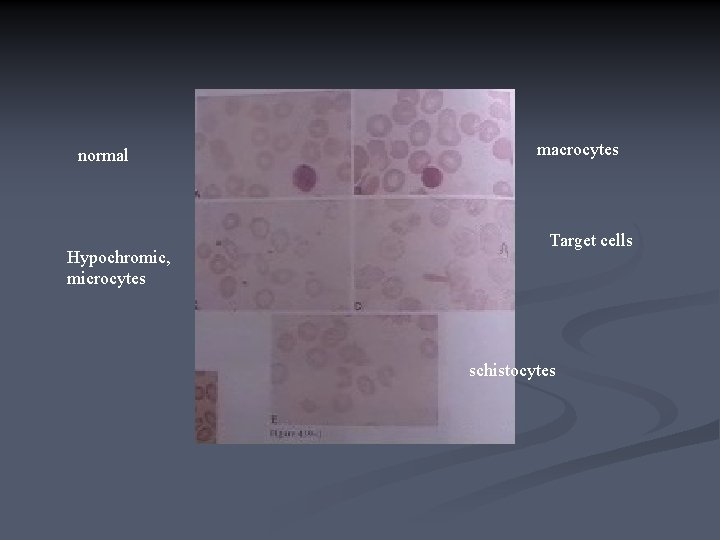 normal Hypochromic, microcytes macrocytes Target cells schistocytes 