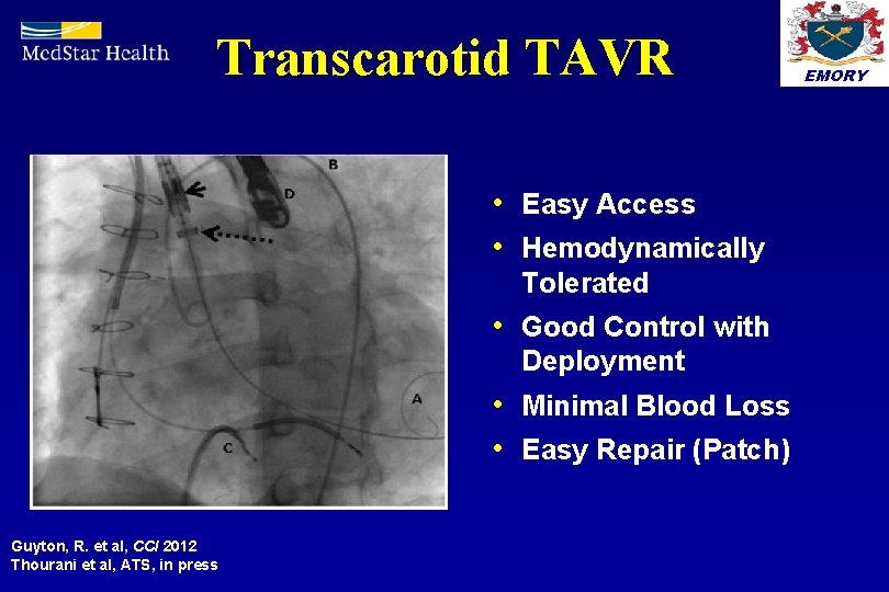 Transcarotid TAVR • Easy Access • Hemodynamically Tolerated • Good Control with Deployment •