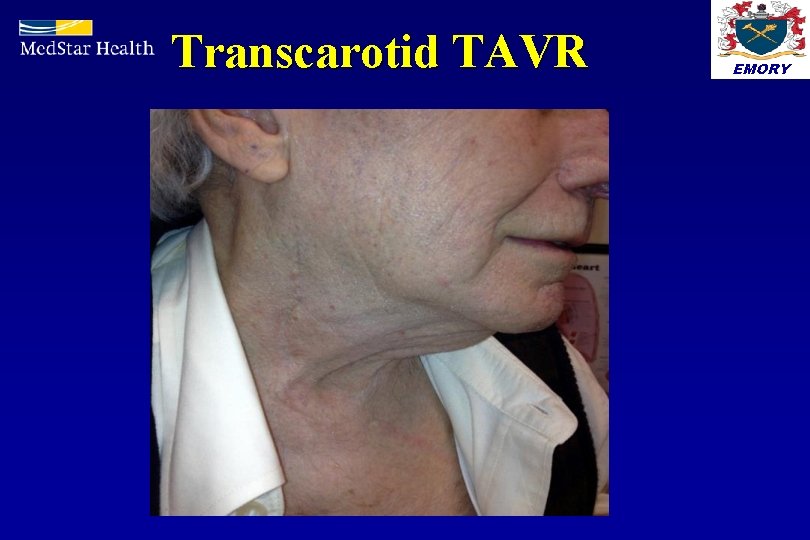 Transcarotid TAVR EMORY 