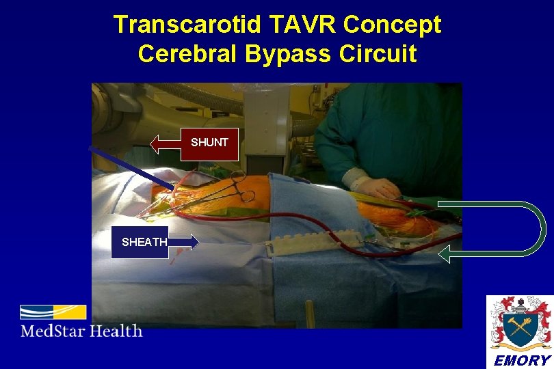 Transcarotid TAVR Concept Cerebral Bypass Circuit SHUNT SHEATH EMORY 