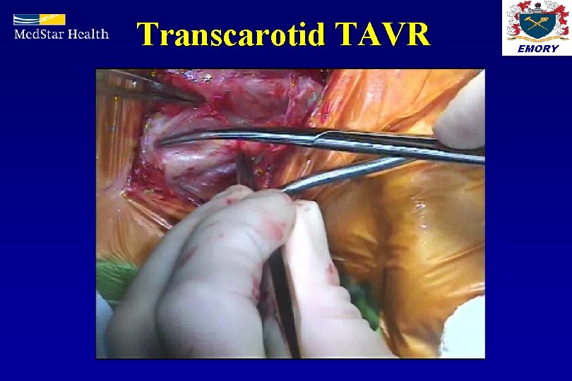 Transcarotid TAVR EMORY 