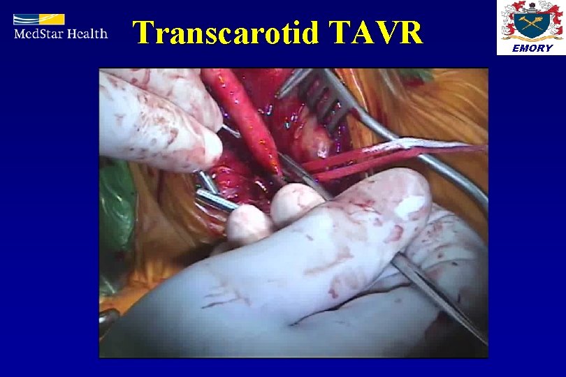 Transcarotid TAVR EMORY 