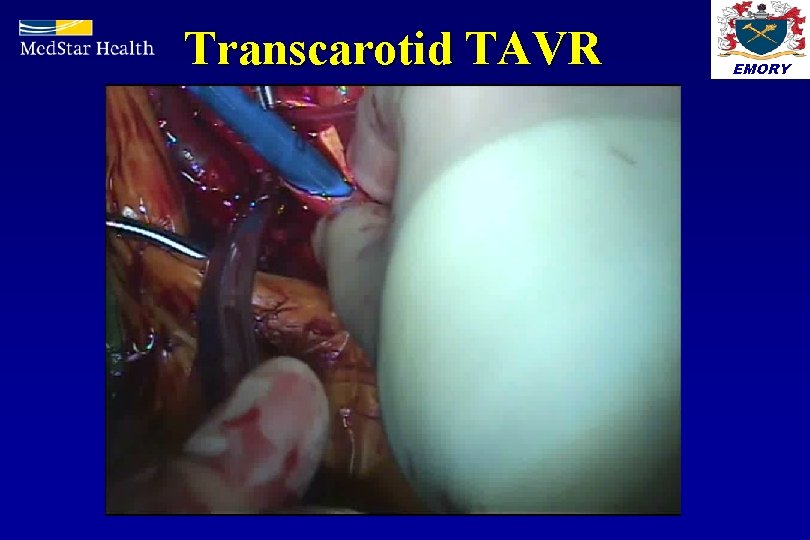 Transcarotid TAVR EMORY 