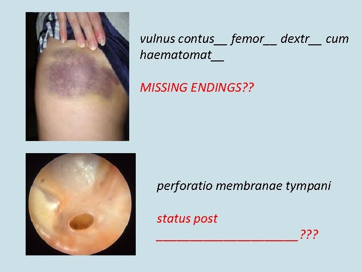 vulnus contus__ femor__ dextr__ cum haematomat__ MISSING ENDINGS? ? perforatio membranae tympani status post vulnus contus__ femor__ dextr__ cum haematomat__ MISSING ENDINGS? ? perforatio membranae tympani status post