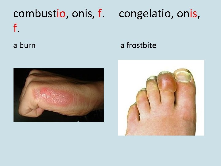 combustio, onis, f. f. congelatio, onis, a burn a frostbite combustio, onis, f. f. congelatio, onis, a burn a frostbite