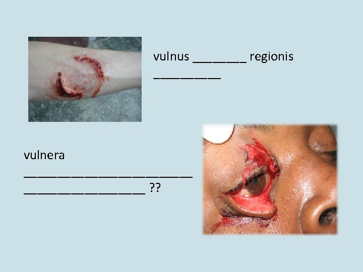 vulnus ____ regionis _____ vulnera _____________ ? ? vulnus ____ regionis _____ vulnera _____________ ? ?