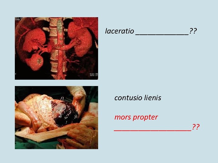 laceratio _______? ? contusio lienis mors propter __________? ? laceratio _______? ? contusio lienis mors propter __________? ?