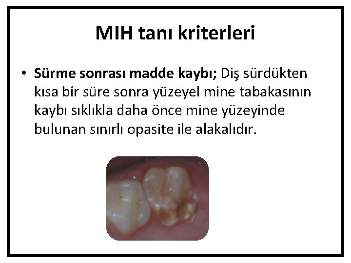 MIH tanı kriterleri • Sürme sonrası madde kaybı; Diş sürdükten kısa bir süre sonra