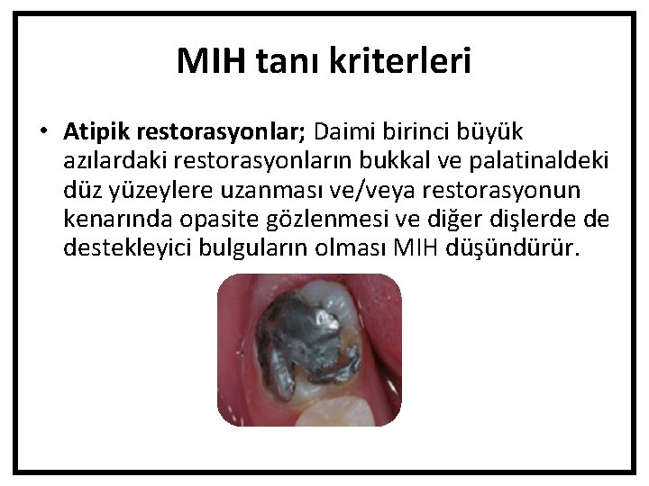 MIH tanı kriterleri • Atipik restorasyonlar; Daimi birinci büyük azılardaki restorasyonların bukkal ve palatinaldeki