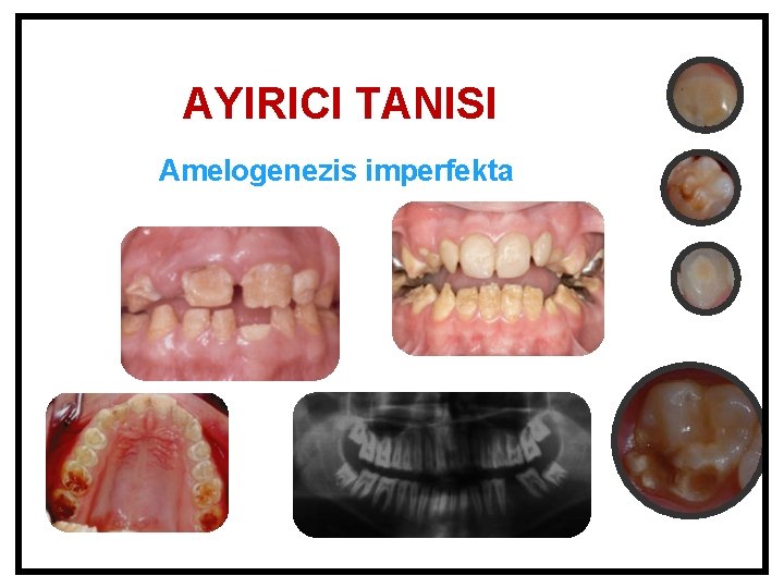 AYIRICI TANISI Amelogenezis imperfekta 