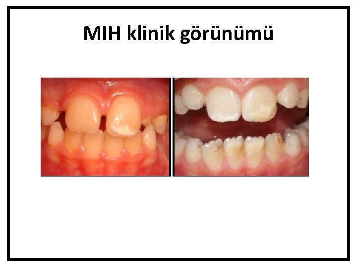 MIH klinik görünümü 