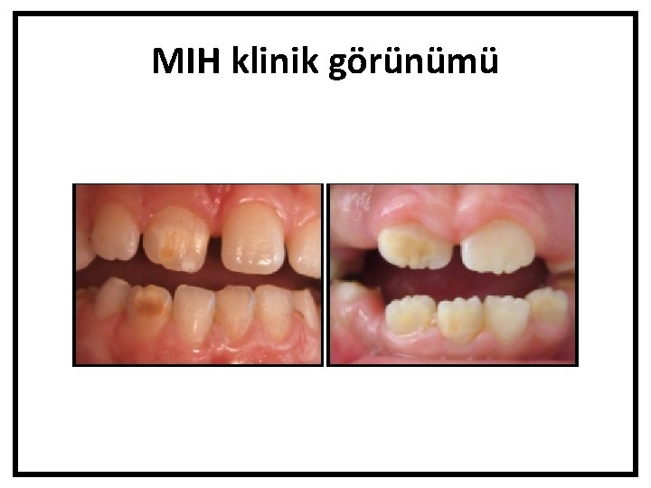 MIH klinik görünümü 