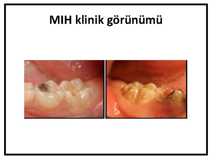 MIH klinik görünümü 