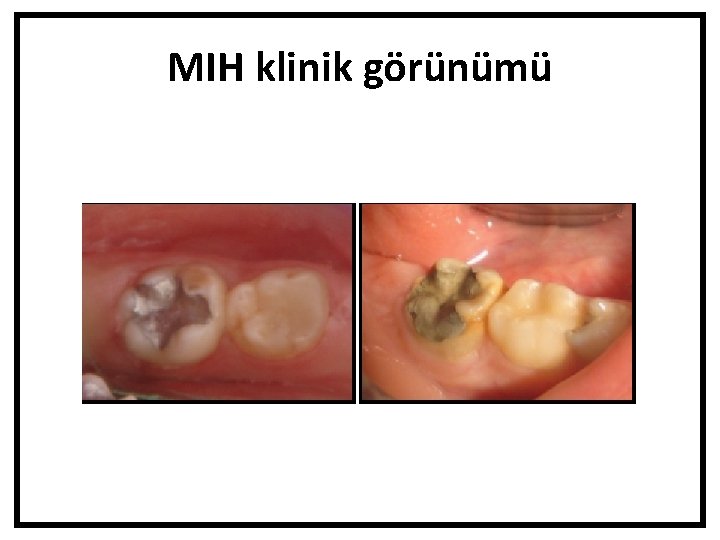 MIH klinik görünümü 