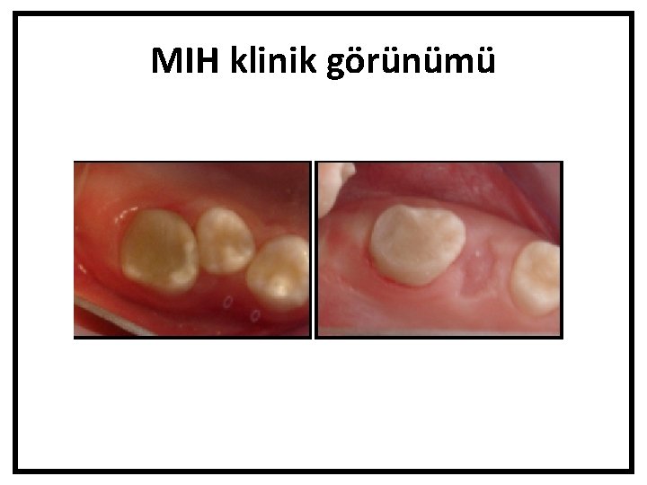 MIH klinik görünümü 