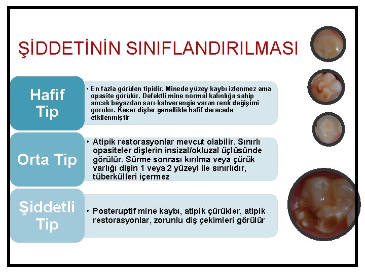 ŞİDDETİNİN SINIFLANDIRILMASI Hafif Tip • En fazla görülen tipidir. Minede yüzey kaybı izlenmez ama