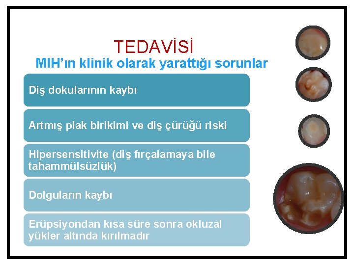 TEDAVİSİ MIH’ın klinik olarak yarattığı sorunlar Diş dokularının kaybı Artmış plak birikimi ve diş