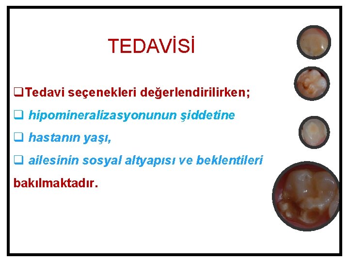 TEDAVİSİ q. Tedavi seçenekleri değerlendirilirken; q hipomineralizasyonunun şiddetine q hastanın yaşı, q ailesinin sosyal