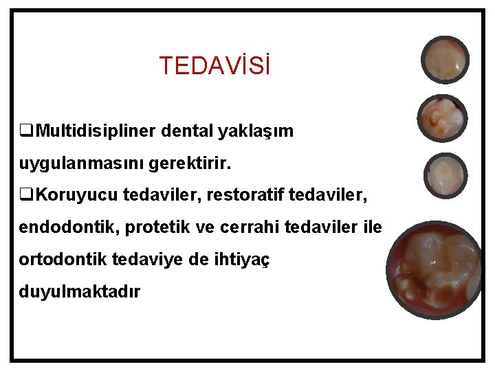 TEDAVİSİ q. Multidisipliner dental yaklaşım uygulanmasını gerektirir. q. Koruyucu tedaviler, restoratif tedaviler, endodontik, protetik