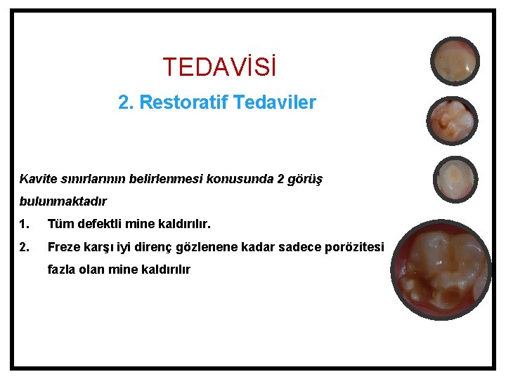 TEDAVİSİ 2. Restoratif Tedaviler Kavite sınırlarının belirlenmesi konusunda 2 görüş bulunmaktadır 1. Tüm defektli