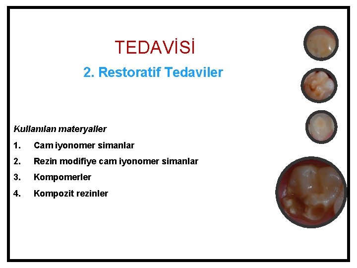 TEDAVİSİ 2. Restoratif Tedaviler Kullanılan materyaller 1. Cam iyonomer simanlar 2. Rezin modifiye cam