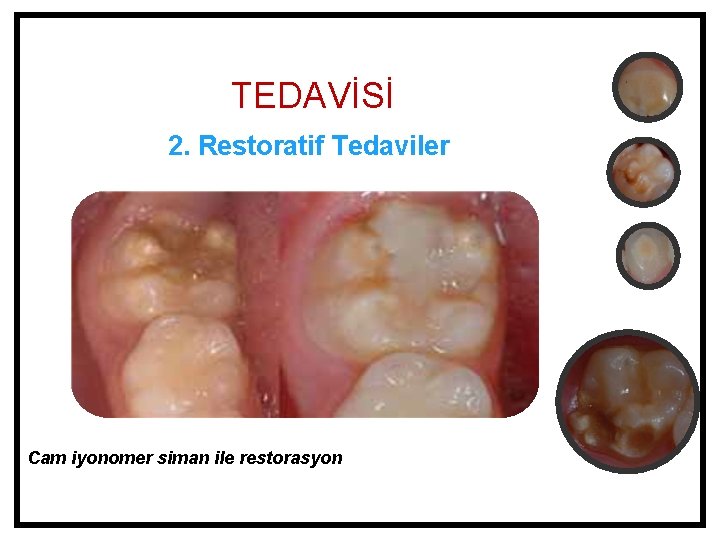 TEDAVİSİ 2. Restoratif Tedaviler Cam iyonomer siman ile restorasyon 