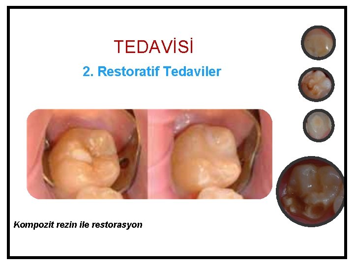 TEDAVİSİ 2. Restoratif Tedaviler Kompozit rezin ile restorasyon 