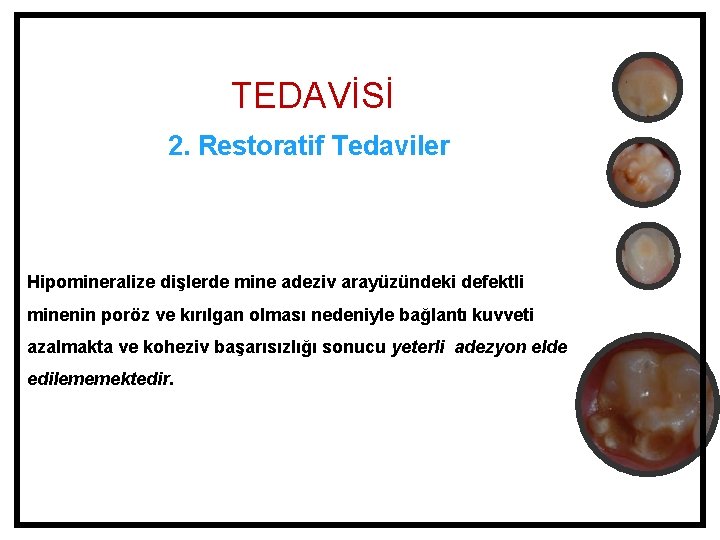 TEDAVİSİ 2. Restoratif Tedaviler Hipomineralize dişlerde mine adeziv arayüzündeki defektli minenin poröz ve kırılgan