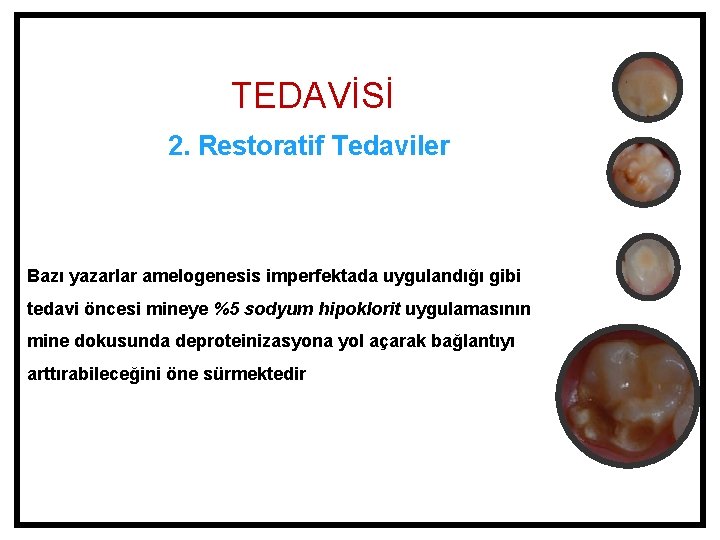 TEDAVİSİ 2. Restoratif Tedaviler Bazı yazarlar amelogenesis imperfektada uygulandığı gibi tedavi öncesi mineye %5