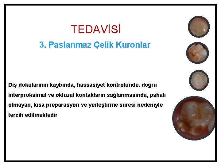 TEDAVİSİ 3. Paslanmaz Çelik Kuronlar Diş dokularının kaybında, hassasiyet kontrolünde, doğru interproksimal ve okluzal