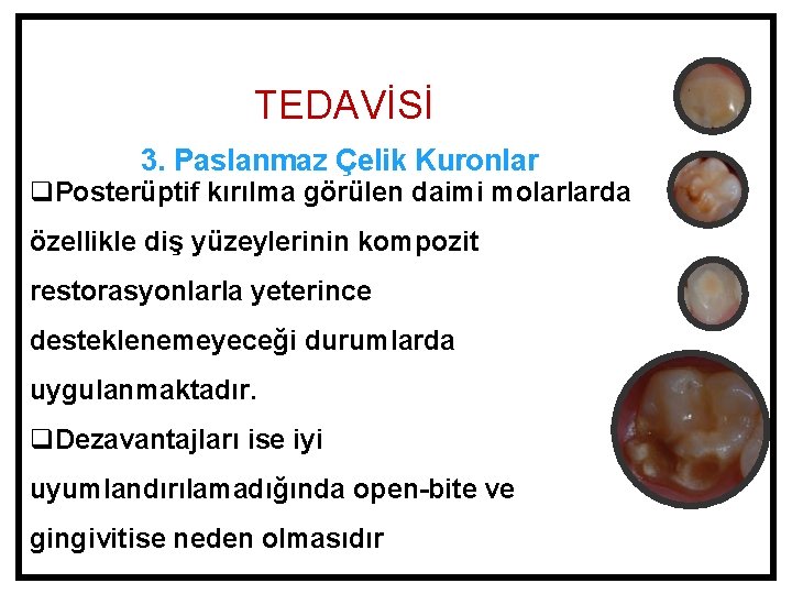 TEDAVİSİ 3. Paslanmaz Çelik Kuronlar q. Posterüptif kırılma görülen daimi molarlarda özellikle diş yüzeylerinin