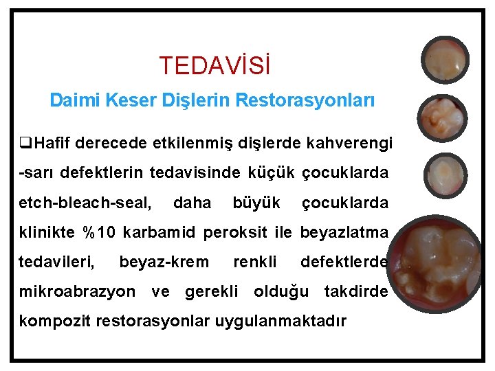 TEDAVİSİ Daimi Keser Dişlerin Restorasyonları q. Hafif derecede etkilenmiş dişlerde kahverengi -sarı defektlerin tedavisinde